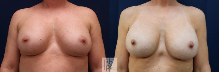 Before & After Corrective Breast Surgery Case 643 Front View in Los Angeles & Torrance, CA, CA