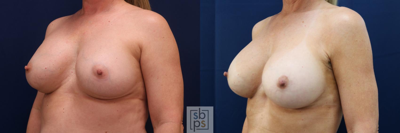 Before & After Corrective Breast Surgery Case 643 Left Oblique View in Torrance & Los Angeles, CA, CA