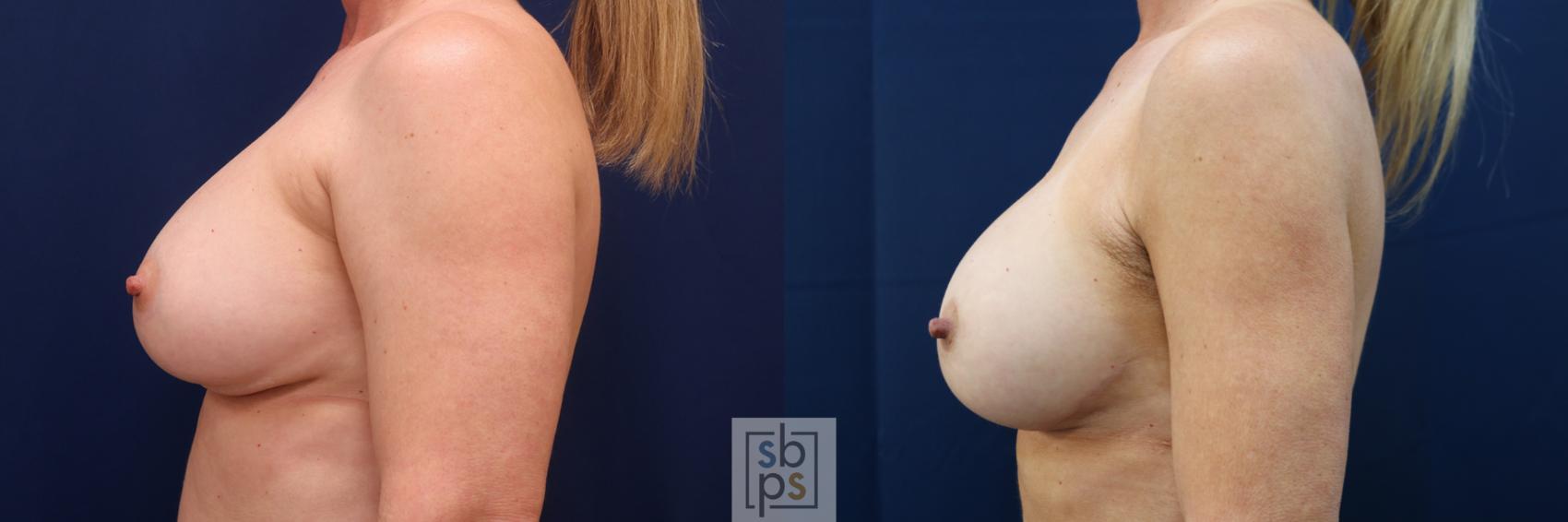 Before & After Corrective Breast Surgery Case 643 Left Side View in Torrance & Los Angeles, CA, CA