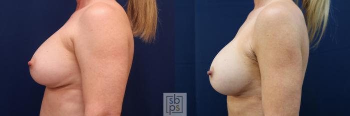 Before & After Corrective Breast Surgery Case 643 Left Side View in Los Angeles & Torrance, CA, CA