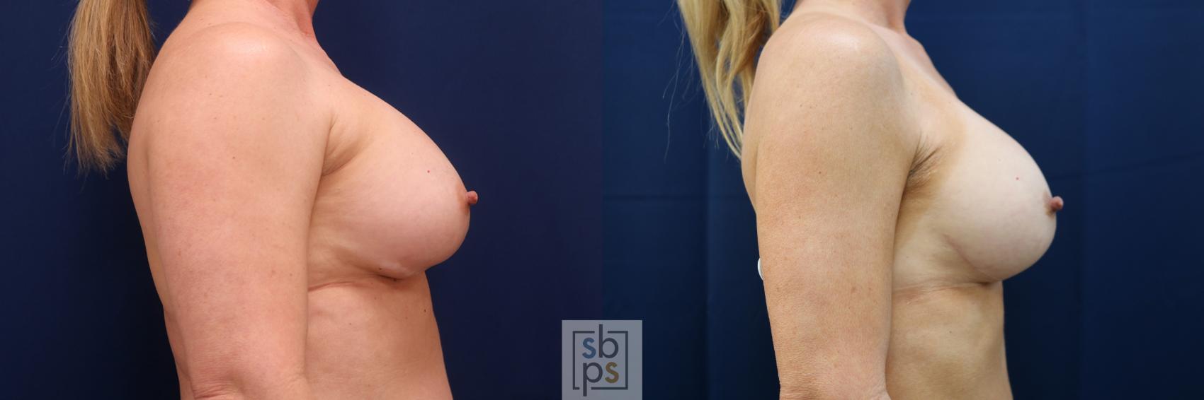 Before & After Corrective Breast Surgery Case 643 Right Side View in Torrance & Los Angeles, CA, CA