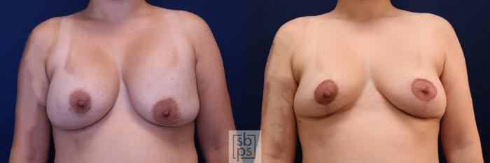 Before & After Corrective Breast Surgery Case 651 Front View in Los Angeles & Torrance, CA, CA