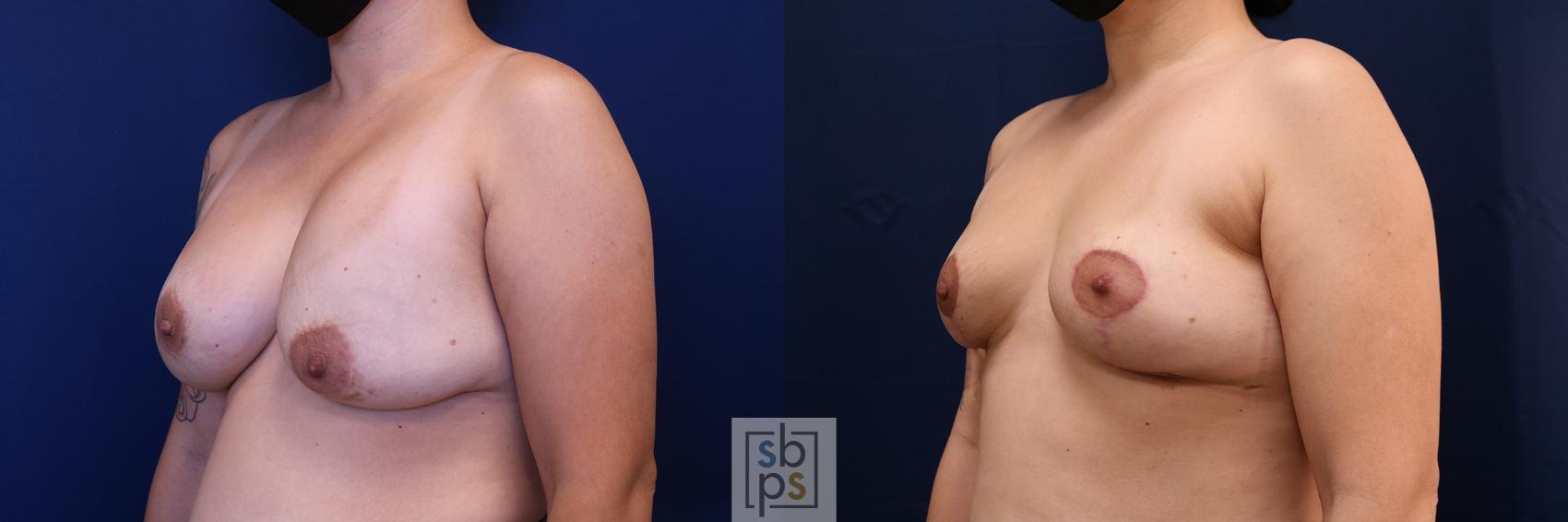 Before & After Corrective Breast Surgery Case 651 Left Oblique View in Torrance & Los Angeles, CA, CA