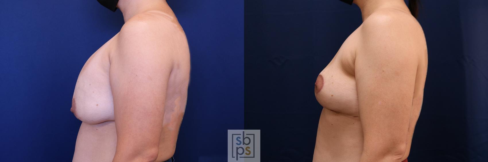 Before & After Corrective Breast Surgery Case 651 Left Side View in Torrance & Los Angeles, CA, CA