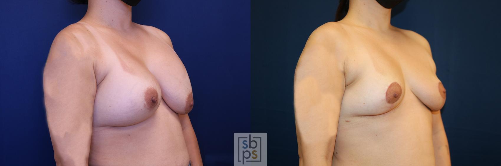 Before & After Corrective Breast Surgery Case 651 Right Oblique View in Torrance & Los Angeles, CA, CA
