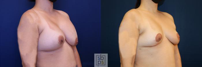 Before & After Corrective Breast Surgery Case 651 Right Oblique View in Los Angeles & Torrance, CA, CA