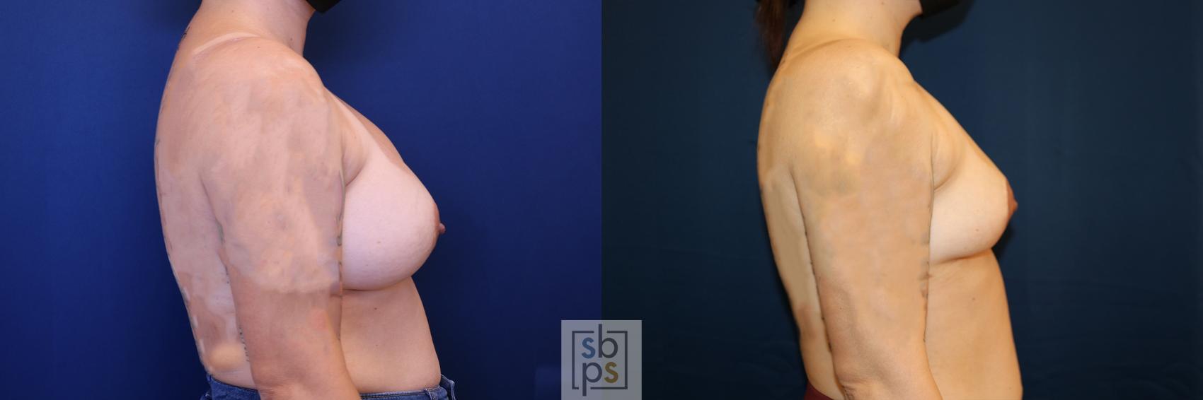 Before & After Corrective Breast Surgery Case 651 Right Side View in Torrance & Los Angeles, CA, CA