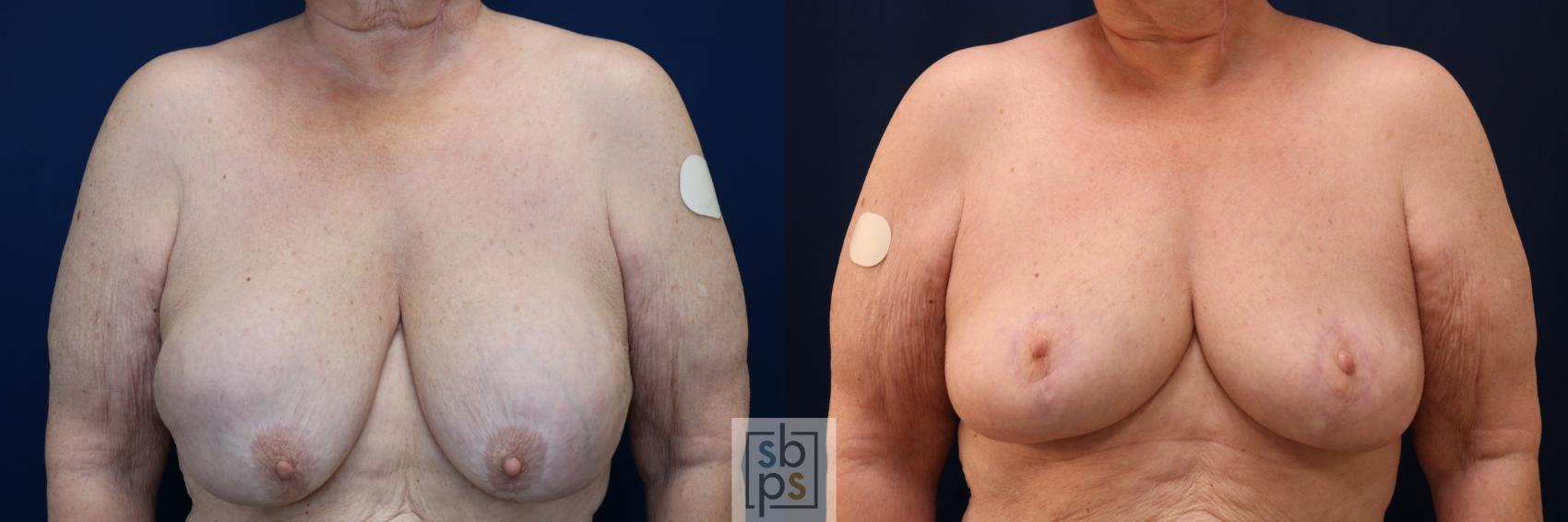 Before & After Corrective Breast Surgery Case 717 Front View in Los Angeles & Torrance, CA, CA