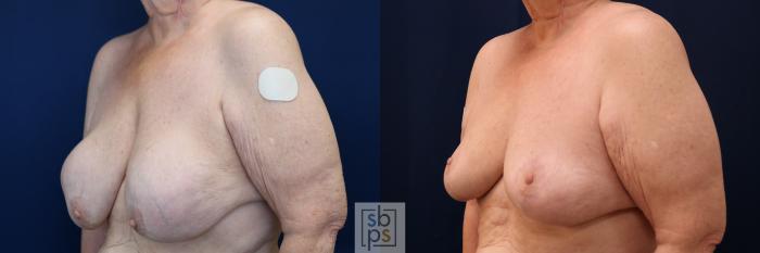 Before & After Corrective Breast Surgery Case 717 Left Oblique View in Los Angeles & Torrance, CA, CA