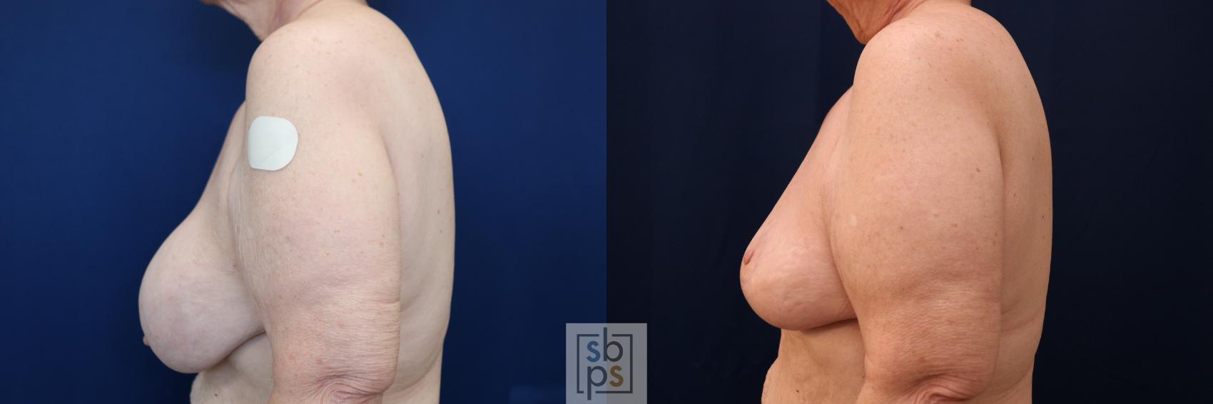 Before & After Corrective Breast Surgery Case 717 Left Side View in Torrance & Los Angeles, CA, CA