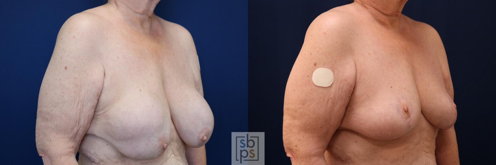 Before & After Corrective Breast Surgery Case 717 Right Oblique View in Torrance & Los Angeles, CA, CA