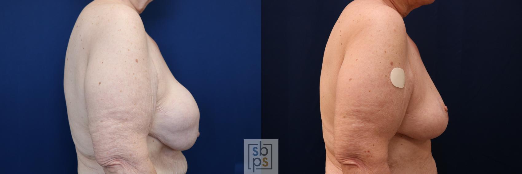 Before & After Corrective Breast Surgery Case 717 Right Side View in Torrance & Los Angeles, CA, CA