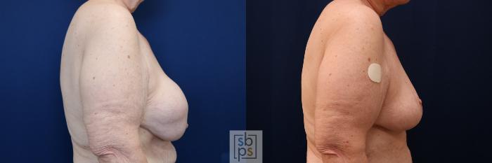 Before & After Corrective Breast Surgery Case 717 Right Side View in Los Angeles & Torrance, CA, CA