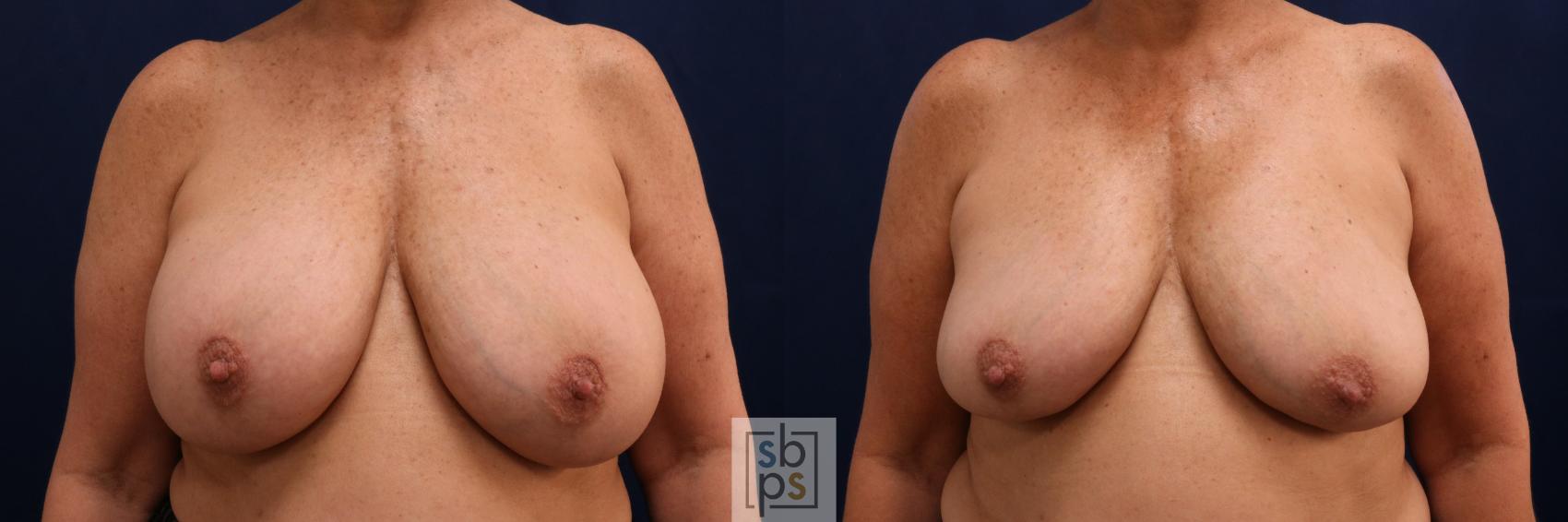 Before & After Corrective Breast Surgery Case 731 Front View in Los Angeles & Torrance, CA, CA