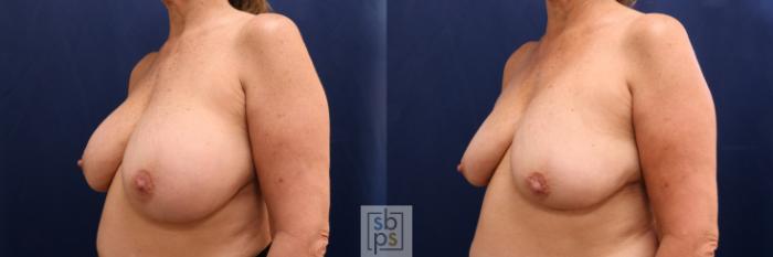 Before & After Corrective Breast Surgery Case 731 Left Oblique View in Los Angeles & Torrance, CA, CA