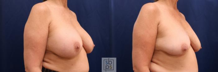 Before & After Corrective Breast Surgery Case 731 Right Oblique View in Los Angeles & Torrance, CA, CA