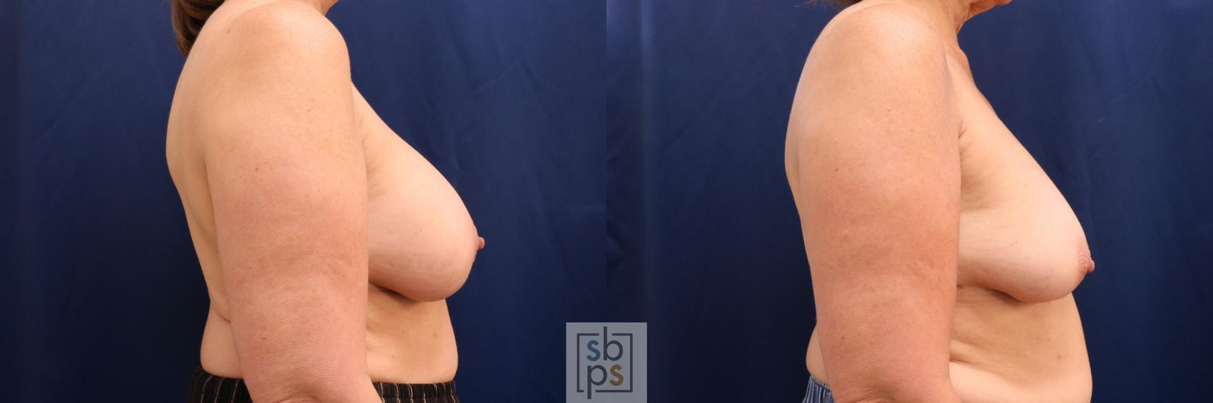 Before & After Corrective Breast Surgery Case 731 Right Side View in Torrance & Los Angeles, CA, CA