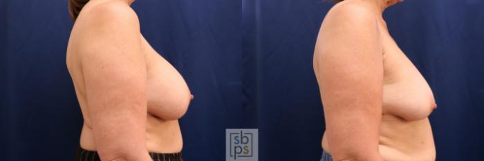 Before & After Corrective Breast Surgery Case 731 Right Side View in Los Angeles & Torrance, CA, CA