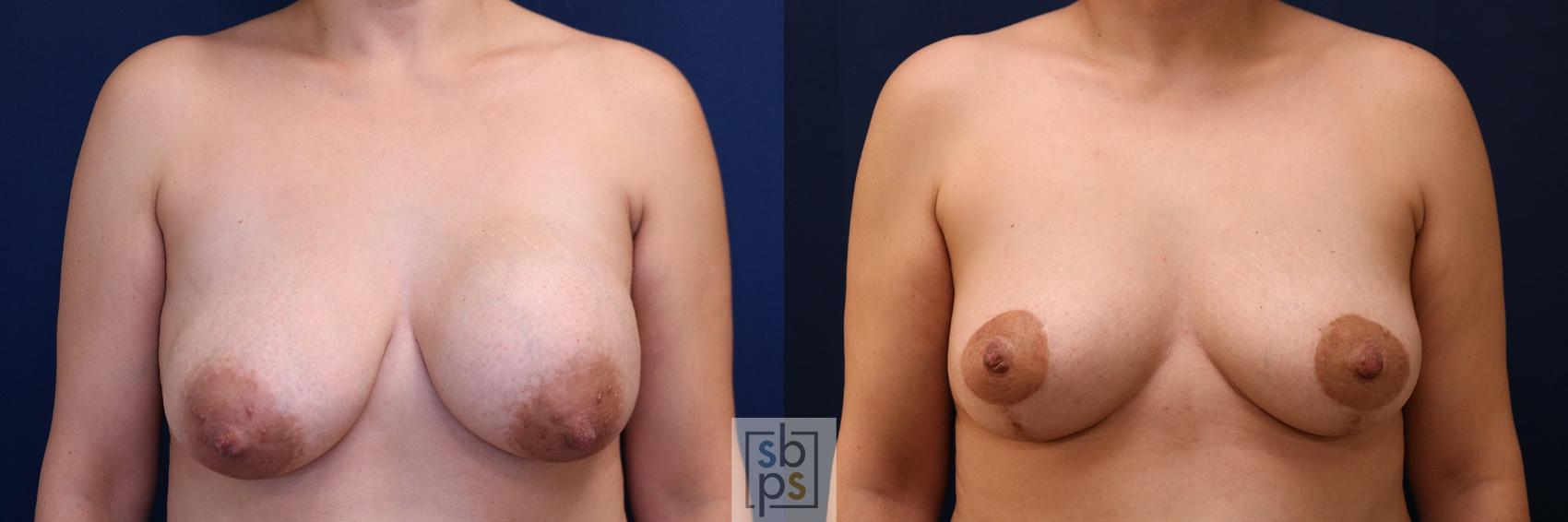Before & After Corrective Revision Breast Surgery Case 757 Front View in Los Angeles, Torrance & Long Beach, CA