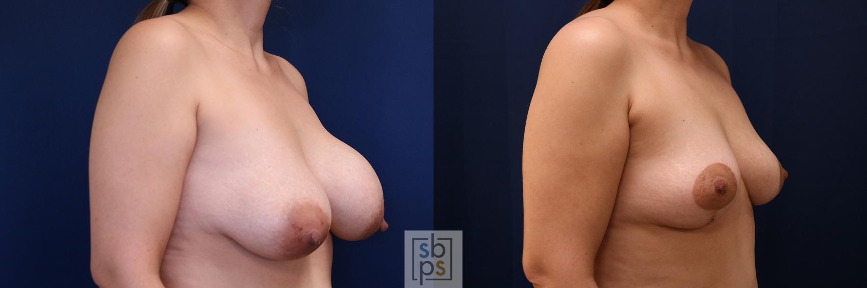 Before & After Corrective Revision Breast Surgery Case 757 Right Oblique View in Los Angeles, Torrance & Long Beach, CA