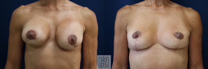 Before & After Corrective Revision Breast Surgery Case 758 Front View in Los Angeles, Torrance & Long Beach, CA