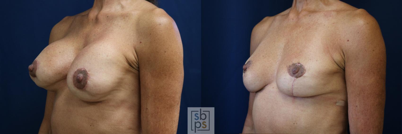 Before & After Corrective Revision Breast Surgery Case 758 Left Oblique View in Los Angeles, Torrance & Long Beach, CA