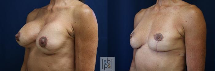 Before & After Corrective Revision Breast Surgery Case 758 Left Oblique View in Los Angeles, Torrance & Long Beach, CA