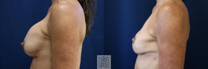Before & After Corrective Revision Breast Surgery Case 758 Left Side View in Los Angeles, Torrance & Long Beach, CA