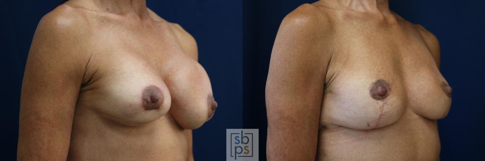 Before & After Corrective Revision Breast Surgery Case 758 Right Oblique View in Los Angeles, Torrance & Long Beach, CA