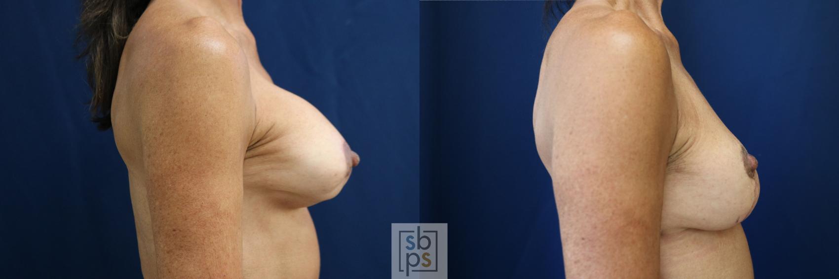 Before & After Corrective Revision Breast Surgery Case 758 Right Side View in Los Angeles, Torrance & Long Beach, CA
