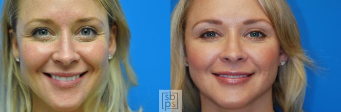 Before & After Dermal Fillers Case 140 View #1 View in Torrance, CA