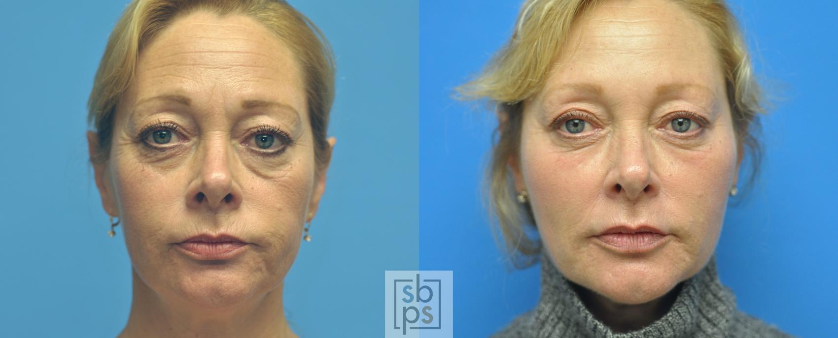 Before & After Dermal Fillers Case 143 View #1 View in Torrance, CA