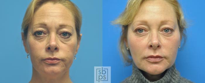 Before & After Dermal Fillers Case 143 View #1 View in Torrance, CA