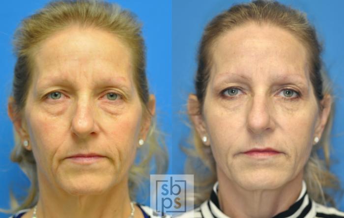 Before & After Dermal Fillers Case 144 View #1 View in Torrance, CA
