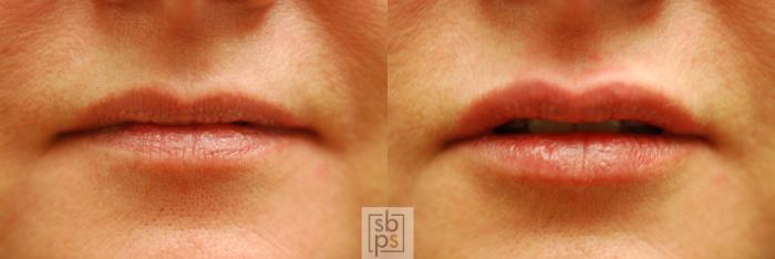 Before & After Dermal Fillers Case 149 View #1 View in Torrance, CA