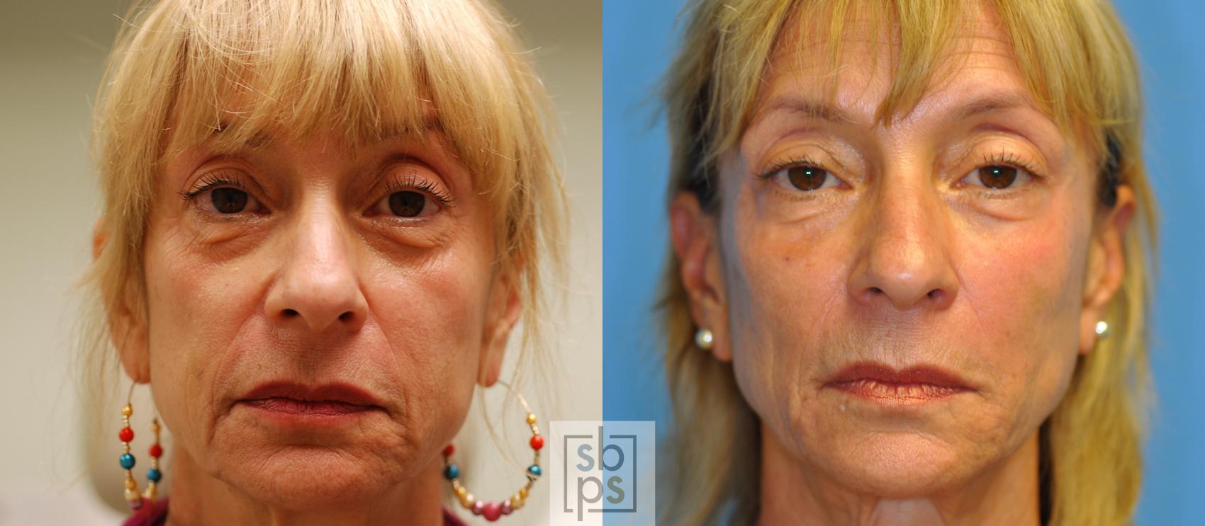 Before & After Dermal Fillers Case 151 View #1 View in Torrance, CA