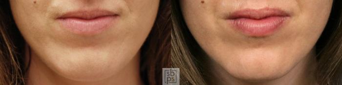 Before & After Dermal Fillers Case 241 View #1 View in Torrance, CA