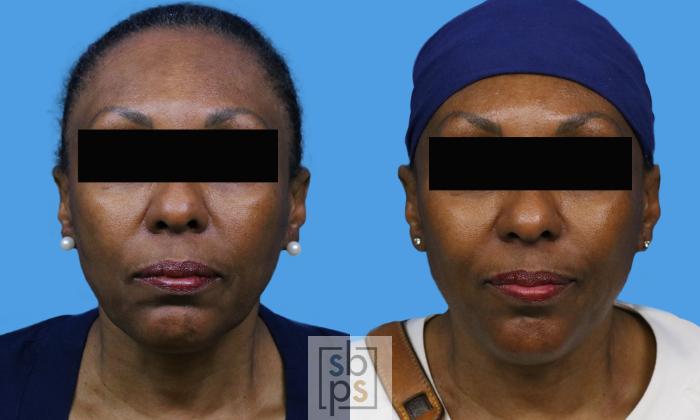 Before & After Dermal Fillers Case 246 View #1 View in Torrance, CA