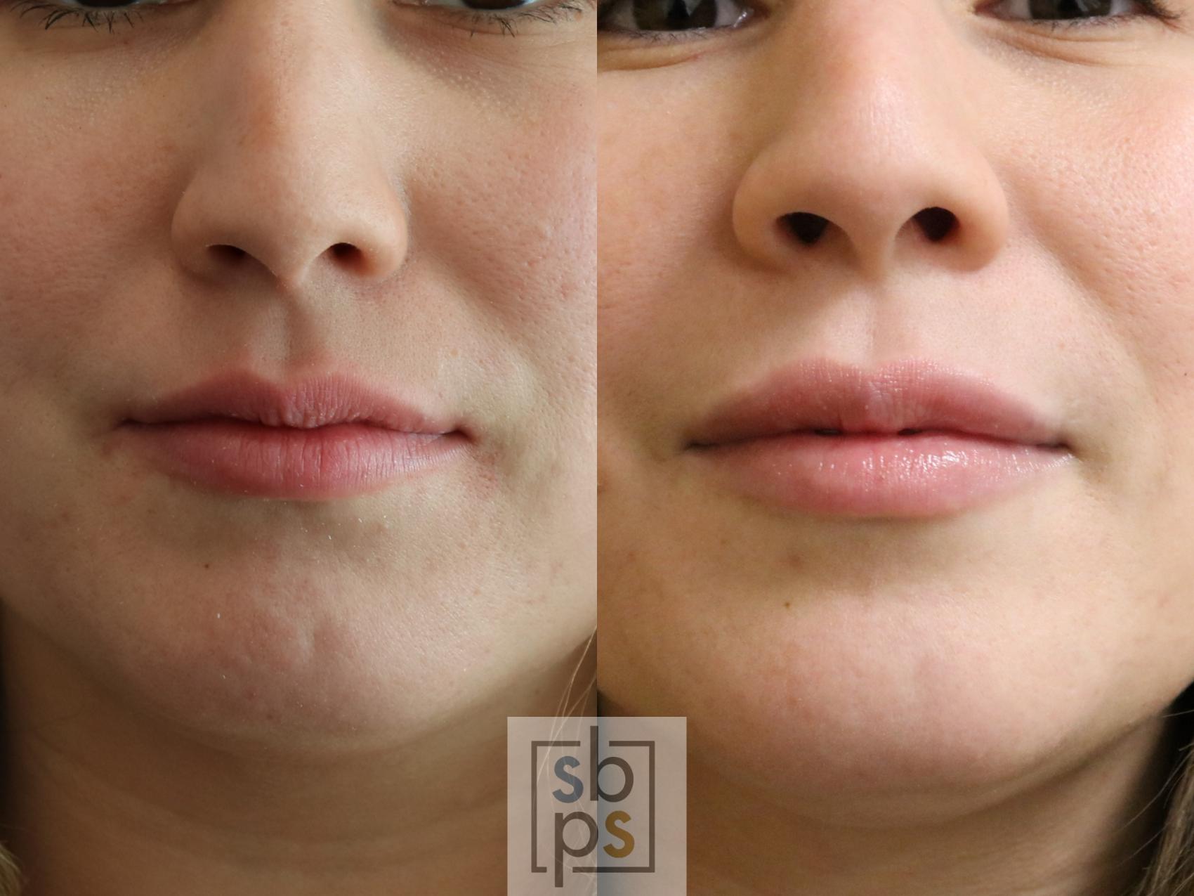 Before & After Dermal Fillers Case 269 View #1 View in Torrance, CA