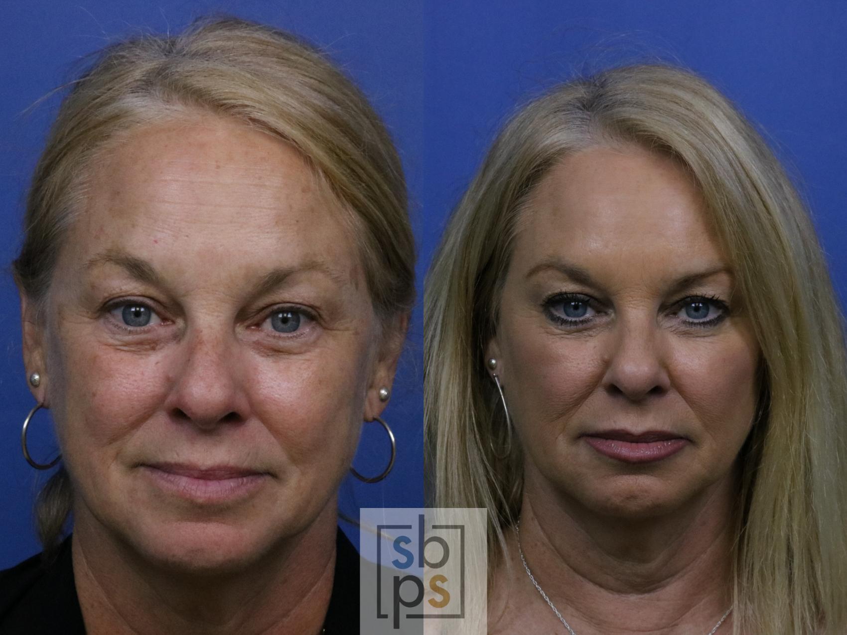 Before & After Dermal Fillers Case 270 View #1 View in Torrance, CA