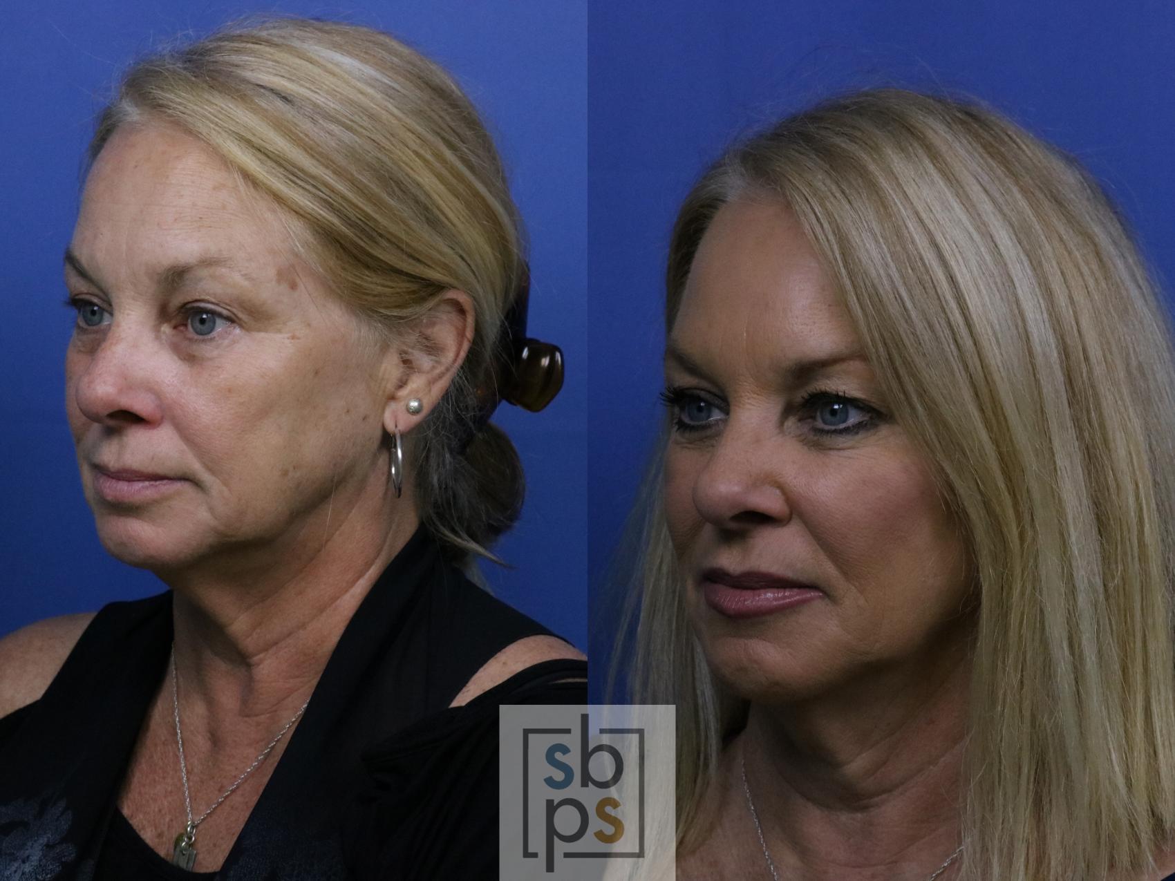 Before & After Dermal Fillers Case 270 View #2 View in Torrance & Los Angeles, CA, CA