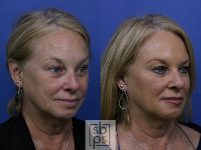 Before & After Dermal Fillers Case 270 View #3 View in Torrance, CA