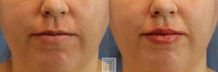 Before & After Dermal Fillers Case 388 Front View in Los Angeles & Torrance, CA, CA