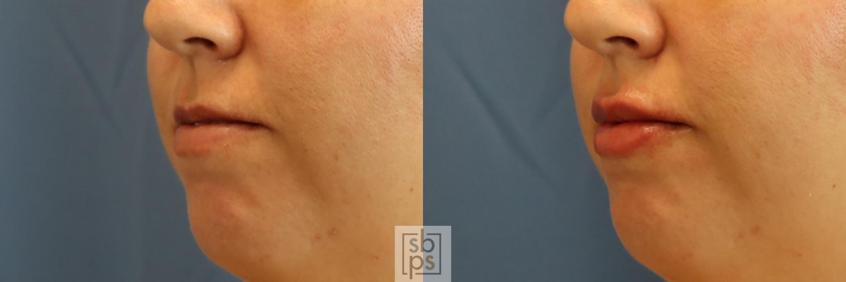 Before & After Dermal Fillers Case 388 Left Oblique View in Torrance & Los Angeles, CA, CA