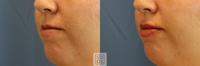 Before & After Dermal Fillers Case 388 Left Oblique View in Los Angeles & Torrance, CA, CA