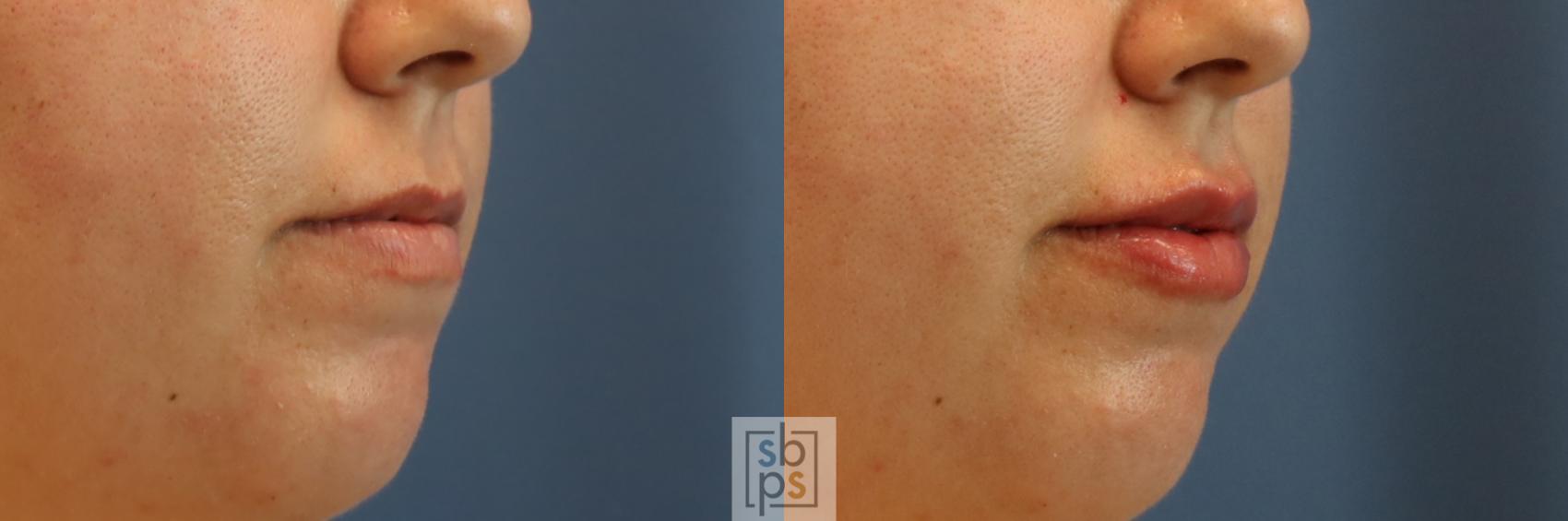 Before & After Dermal Fillers Case 388 Right Oblique View in Torrance & Los Angeles, CA, CA
