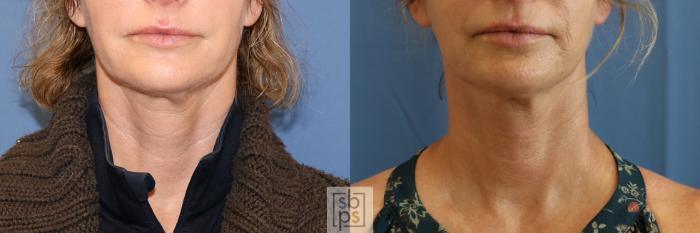 Before & After Dermal Fillers Case 391 Front View in Torrance, CA