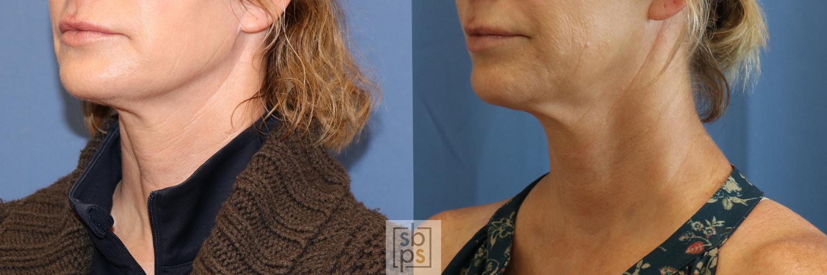 Before & After Dermal Fillers Case 391 Left Oblique View in Torrance & Los Angeles, CA, CA