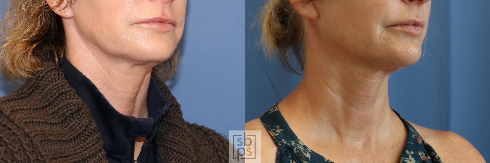 Before & After Dermal Fillers Case 391 Right Oblique View in Torrance & Los Angeles, CA, CA