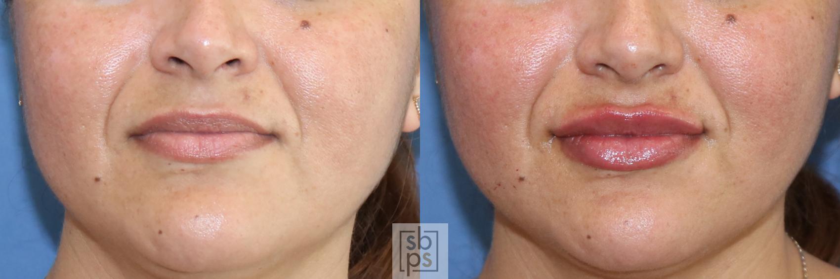 Before & After Dermal Fillers Case 392 Front View in Torrance, CA
